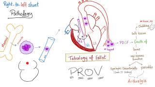 The Megakaryocytes Clinical Significance Tetralogy of Fallot Nail Clubbing Cardiology [upl. by Ilime]