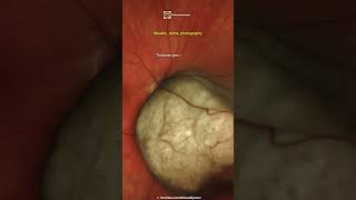 Choroidal Melanoma [upl. by Davidde]