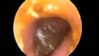 Acute Otitis media tympanic blister [upl. by Dnamron]