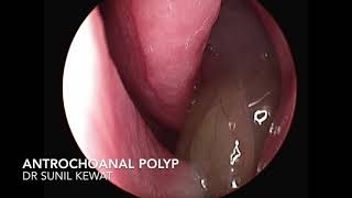 Antro Choanal Polyp  Nasal Endoscopy [upl. by Yreffej]