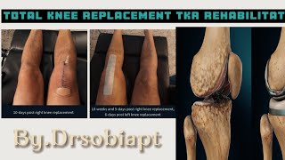 Total Knee Replacement Surgery Total Knee Knee Replacement Exercises  Post op rehabilitation [upl. by Leynwad748]