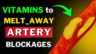 Remove Artery Plaque Naturally 6 Powerful Vitamins [upl. by Kimball]