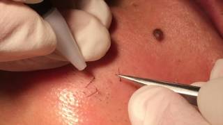 Electrolysis hair removal close up [upl. by Stephan]