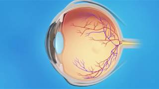 Cystoid Macular Edema Treatment  Medication Injection [upl. by Oranneg]