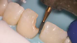 Teeth Bonding  Front tooth filling EXPLAINED [upl. by Yaffit97]