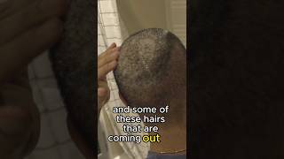 removing scabs after a hair transplant hairloss hairtransplant [upl. by Eiramac]