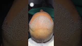 Hair Transplant Result  BIG FUE Hair Transplant Before amp After  3500 Grafts Hair Transplant Result [upl. by Aciram]