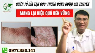 Chữa Tổ Đỉa Tận Gốc Thuốc Đông Dược Gia Truyền Mang Lại Hiệu Quả Bền Vững [upl. by Goodill]