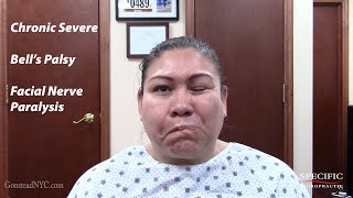 Chronic Severe Bells Palsy Facial Nerve Paralysis HELPED by Dr Suh Specific Chiropractic [upl. by Marchese]