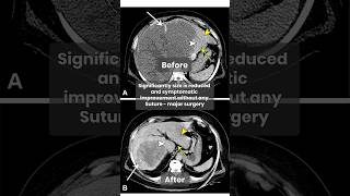 Liver Hemangioma Treatment Embolization Procedure Explained  Dr Amol Lahoti shortsfeed2024 [upl. by Notirb]