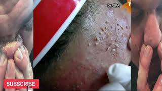 acné severe visage extraction  Dr SPA 15 [upl. by Philcox923]