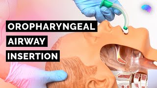 Oropharyngeal Airway Insertion  Guedel  OPA  ABCDE Emergency  OSCE Guide  UKMLA  CPSA [upl. by Andrei]