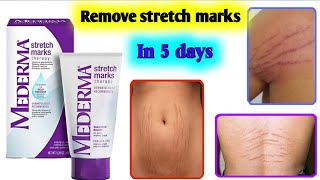 Mederma stretch marks therapy cream  Review  Remove stretch marks [upl. by Amari292]