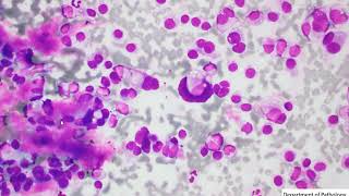 Thyroid FNA cytology  Medullary thyroid carcinoma [upl. by Benoit]