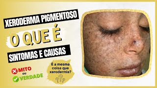 Xeroderma Pigmentoso  O que é sintomas e causas [upl. by Ainahtan]