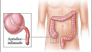 Primeros síntomas del APENDICITIS Mi Historia [upl. by Dickey]