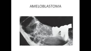 Maxillofacial radiology  MULTILOCULAR RADIOLUCENCY OF JAW [upl. by Isyak459]