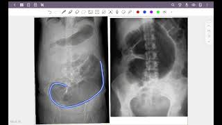 Abdominal radiograph part 3  calcification amp volvulus [upl. by Olnek]