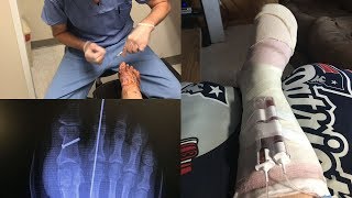 BUNION SURGERY RECOVERY AND PAIN MANAGEMENT FIRST 5 WEEKS [upl. by Elyak]