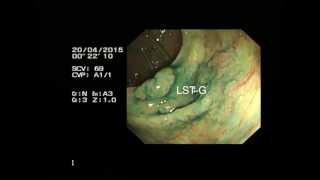 Piecemeal EMR of caecal LST [upl. by Filip]