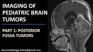 Imaging of Pediatric Brain Tumors part 1 Posterior fossa tumors [upl. by Barry640]