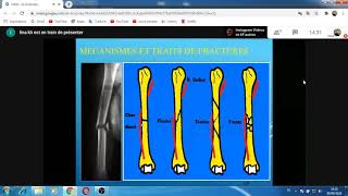 Fracture de diaphyse humérale [upl. by Aneres679]