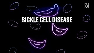 What is Sickle Cell Disease Can Science Cure it [upl. by Elane]