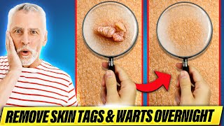 Easy Way to Remove Skin Tags amp Warts Overnight [upl. by Chicky]