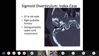 Pulsatile Tinnitus Dr Douglas Mattox Emory University [upl. by Taam]