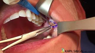 AWAKE Buccal Fat removal [upl. by Conah]