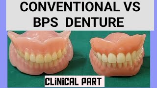 BPS DENTURE clinical procedure part [upl. by Lap]