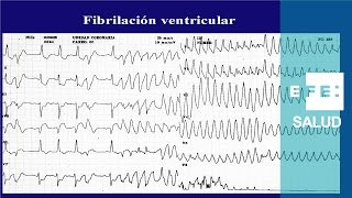 Taquicardia La fibrilación ventricular caos y shock [upl. by Lammond]