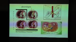 4PLEXO CELIACO HIPOGASTRICO Dr M Casals 2018 [upl. by Manvell]