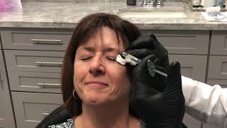 Eyebrow Lift using dermal filler by Dr Nikko [upl. by Wandie]