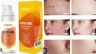 SUNHEAL CYSTIC ACNE TREATMENT CREAM [upl. by Hatti440]