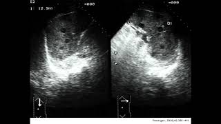 TRAUMATISMO ESPLÉNICO HEMATOMA SUBCAPSULAR HEMATOMA PERICAPSULAR DE BAZO [upl. by Adlez562]