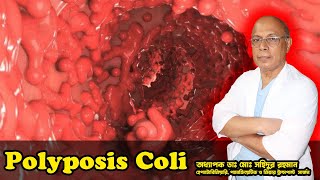 Polyposis Coli । কোলনে অসংখ্য পলিপ । অধ্যাপক ডাঃ মোঃ সহিদুর রহমান।LGSH [upl. by Dnomsaj552]