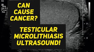 Testicular microlithiasis ultrasound [upl. by Fidelio]