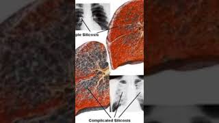 Silicosis Incurable Lung Disease short youtubeshorts occupationaldisease trendingvideo asrclass [upl. by Arda]