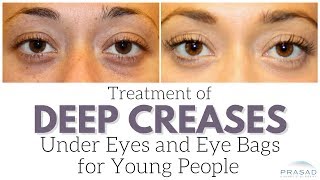 Treatment for Young People with Eye Bags and Deep Creases Under Eyes [upl. by Inait]