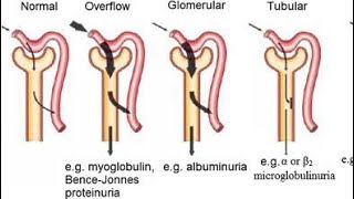 Understanding Overflow proteinuria  Bence Jones protein [upl. by Immak478]