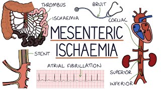 Understanding Mesenteric Ischaemia [upl. by Noivax]