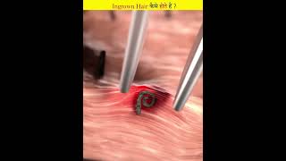 How do ingrown hairs grow [upl. by Noy730]