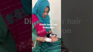 Hirsutism unwantedhairremove laserhairremoval tranding [upl. by Anoyet357]