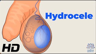 Dealing with Hydrocele Understanding the Condition and How to Manage It [upl. by Ahsircal706]