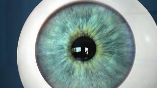 New Keratoconus described [upl. by Ariajay]