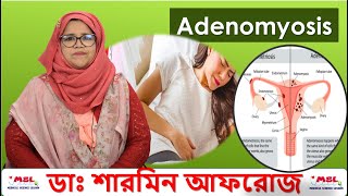 Adenomyosis  অ্যাডেনোমায়োসিস  নারী স্বাস্থ্য  Best homeopathic doctor in Bangladesh [upl. by Naneek564]