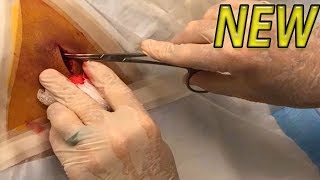 Numbers Infected Back Cyst Procedure BRAND NEW [upl. by Acyssej]