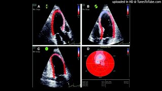 Left ventricular global longitudinal strain GLS analysis using twodimensional 2D speckletracki [upl. by Annahc934]