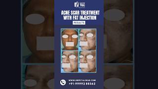 Acne Scar Treatment by Fat Injection BeforeAfter  Acne Scar Treatment in Delhi  Dr PK Talwar [upl. by Annoerb845]